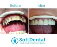 Vorher-nachher-Ergebnis Zirkon-Brücke bei SoftDentalCare Clinic, Lächeln wiederhergestellt