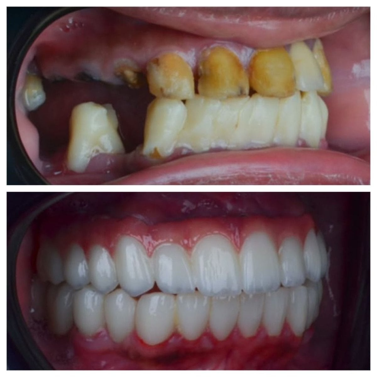 نتيجة قبل وبعد زراعة الأسنان All-on-4 في Omara Dental Centers، استعادة كاملة للابتسامة