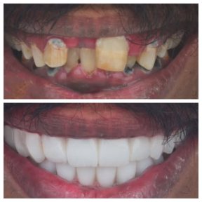 Before and after All-on-4 dental implants result at Omara Dental Centers, smile restoration