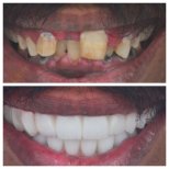 Before and after All-on-4 dental implants result at Omara Dental Centers, smile restoration