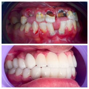 Before and after All-on-4 dental implants result at Omara Dental Centers, full smile restoration