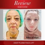 Foto sebelum dan sesudah Pengencangan leher oleh Dr. 