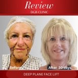 Foto sebelum dan sesudah Pengencangan leher oleh Dr. 