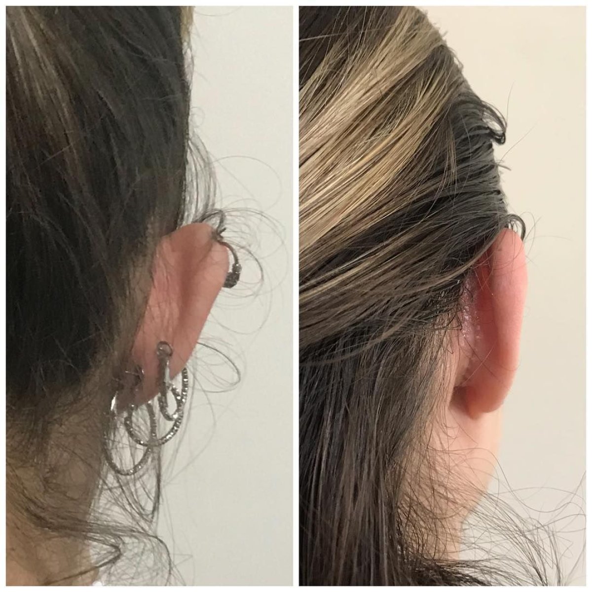 نتائج تجميل الأذن قبل وبعد في عيادة Op. Dr. Sinan Eroglu، جراحة تصحيح الأذن