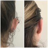 Foto sebelum dan sesudah Otoplasti (operasi telinga) oleh Dr. 