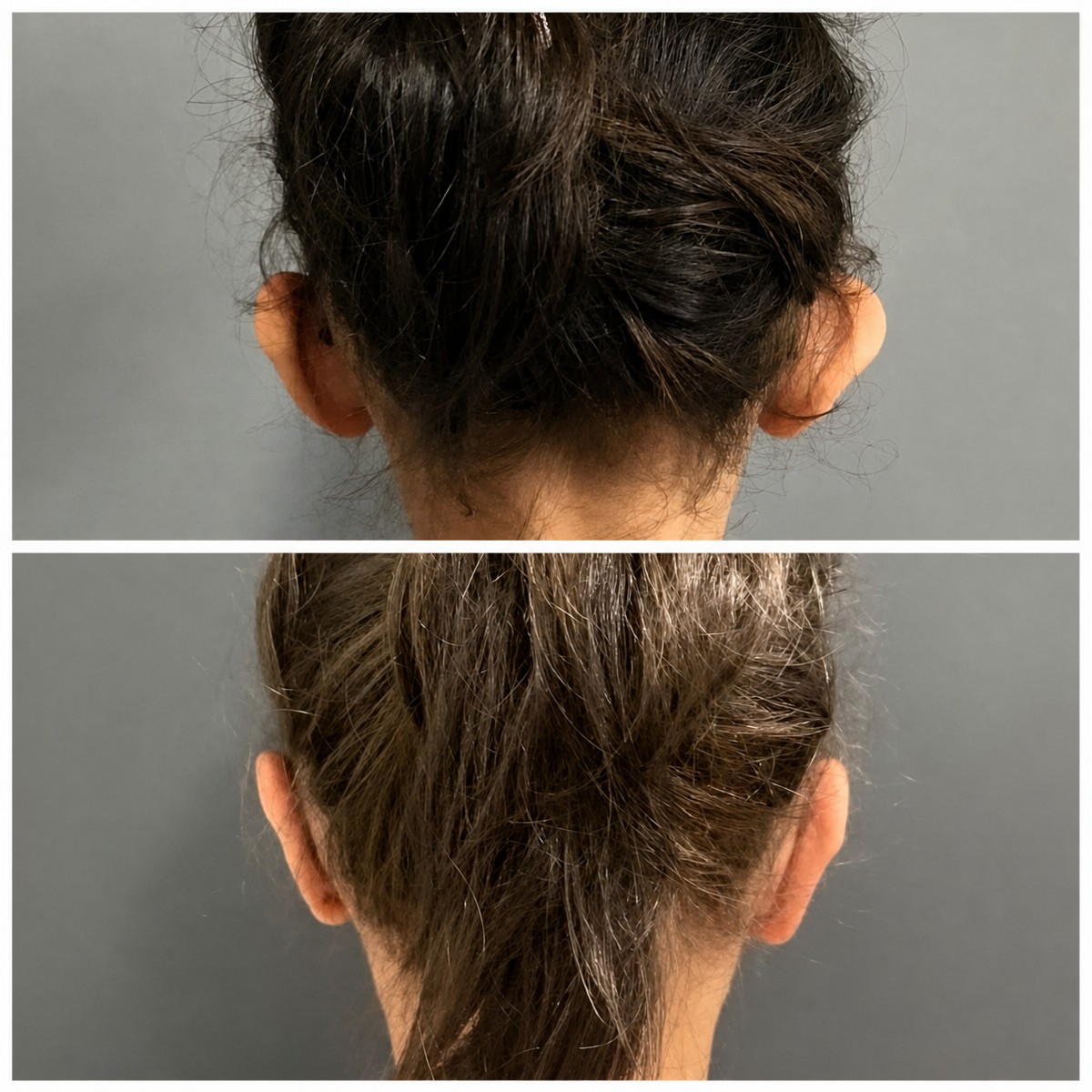 نتائج عملية تجميل الأذن قبل وبعد في عيادة Op. Dr. Sinan Eroglu، تصحيح الأذن