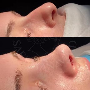 Vorher-nachher-Ergebnisse der Nasenkorrektur in der Dr. Safa Manav Klinik