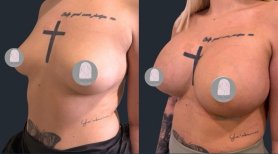 Before and after breast implants with lift at Dr. MED – enhanced breast shape and volume result