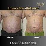 Foto sebelum dan sesudah Sedot lemak oleh Dr. 