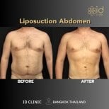 Foto sebelum dan sesudah Sedot lemak oleh Dr. 