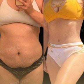 Before and after full body lift results at Memorial Ankara Hospital, improved body contour