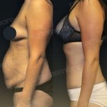 نتائج شد البطن وشفط الدهون قبل وبعد في مستشفى ميموريال أنطاليا، بطن مسطح