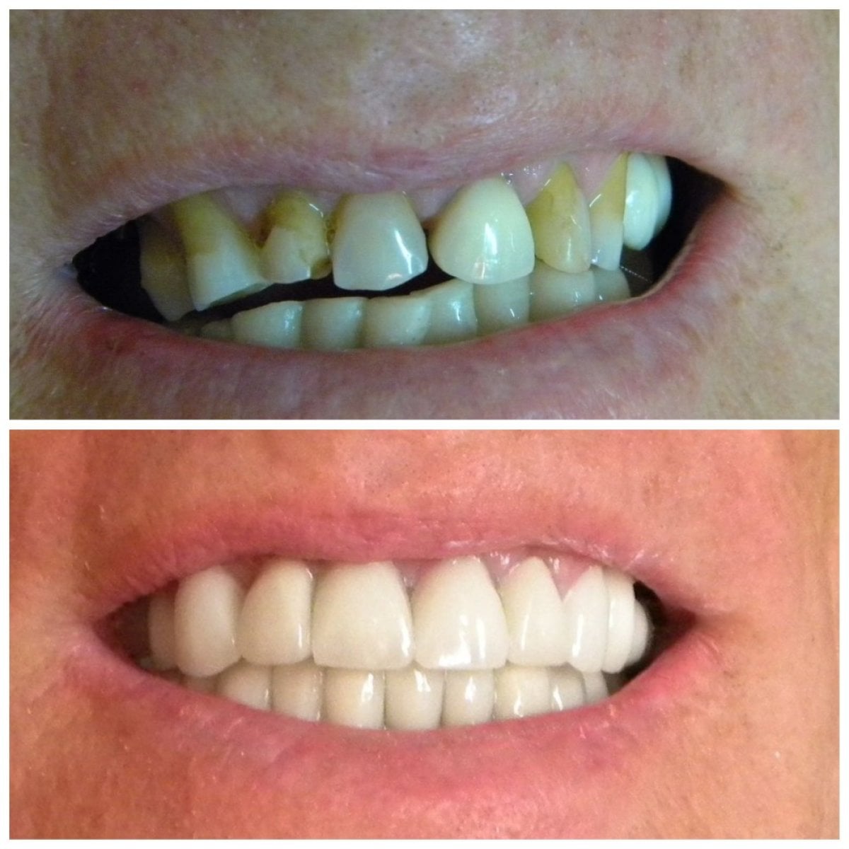 Resultados antes y después de puente dental de zirconia en SoftDentalCare Clinic, restauración de sonrisa