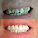 Vorher-nachher-Ergebnis Zirkonbrücke bei SoftDentalCare Clinic, Lächeln wiederhergestellt