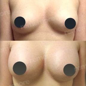 Before and after breast augmentation with fat transfer at Memorial Şişli Hospital, visible results