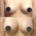 Before and after breast augmentation with fat transfer at Memorial Şişli Hospital, visible results