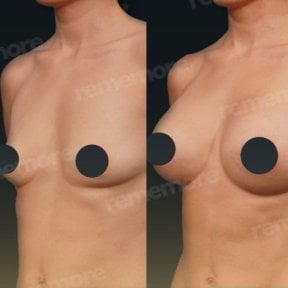 Before and after breast augmentation with fat transfer at Memorial Şişli Hospital, natural result