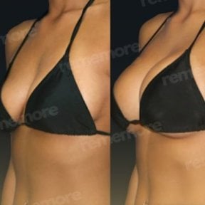 Before and after breast augmentation with fat transfer at Memorial Şişli Hospital, visible results