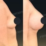 Before and after breast augmentation with fat transfer results at Memorial Şişli Hospital