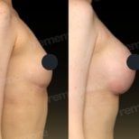 Before and after breast augmentation with fat transfer at Memorial Şişli Hospital, visible result