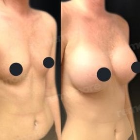 Before and after breast augmentation with fat transfer at Memorial Şişli Hospital, visible results