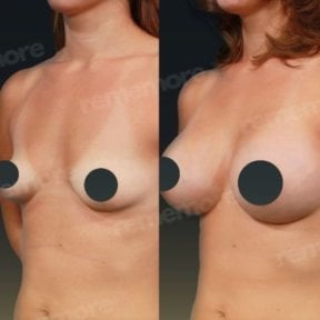 Before and after breast augmentation with fat transfer results at Memorial Şişli Hospital