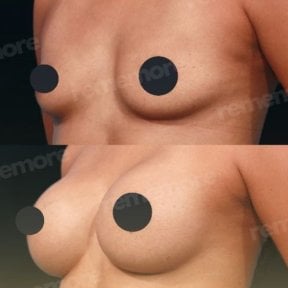Before and after breast augmentation with fat transfer at Memorial Şişli Hospital, natural result