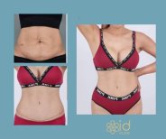 Before and after tummy tuck and liposuction results at ID Clinic Bangkok, flatter abdomen