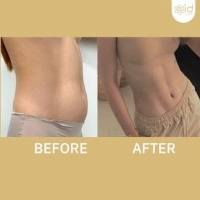 Before and after abdominal etching results at ID Clinic Bangkok, defined six pack abs