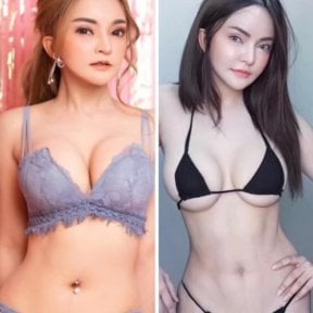 Before and after abdominal etching (six pack abs) results at ID Clinic Bangkok