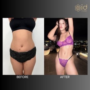 Before and after abdominal etching at ID Clinic Bangkok, defined six pack abs result