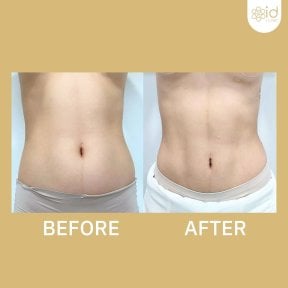 Before and after abdominal etching results at ID Clinic Bangkok, defined six pack abs