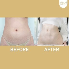 Before and after abdominal etching results at ID Clinic Bangkok – defined six pack abs