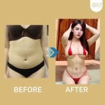 Before and after abdominal etching at ID Clinic Bangkok, six pack abs contouring result