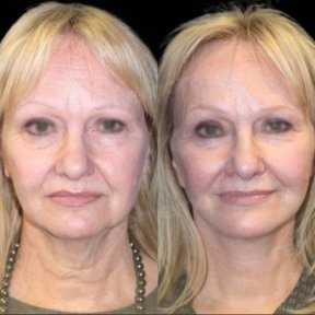 Vorher-nachher-Ergebnis Deep Plane Facelift bei Memorial Göztepe Hospital, Gesichtsverjüngung