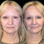 Vorher-nachher-Ergebnis Deep Plane Facelift bei Memorial Göztepe Hospital, Gesichtsverjüngung