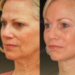 Vorher-nachher-Ergebnis Deep Plane Facelift bei Memorial Göztepe Hospital, Gesichtsverjüngung