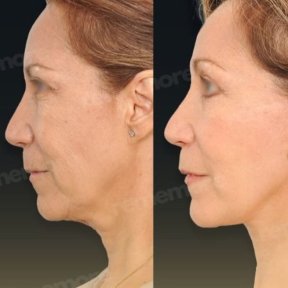 Vorher-nachher-Ergebnisse Deep Plane Facelift bei Memorial Göztepe Hospital, Gesichtsverjüngung