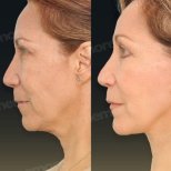 Vorher-nachher-Ergebnisse Deep Plane Facelift bei Memorial Göztepe Hospital, Gesichtsverjüngung