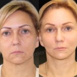 Vorher-nachher-Ergebnis Deep Plane Facelift bei Memorial Göztepe Hospital, Gesichtsverjüngung