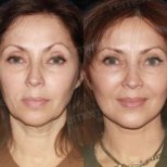 Vorher-nachher-Ergebnis Deep Plane Facelift bei Memorial Göztepe Hospital, Gesichtsverjüngung