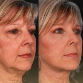 Vorher-nachher-Ergebnis Deep Plane Facelift bei Memorial Göztepe Hospital, Gesichtsverjüngung