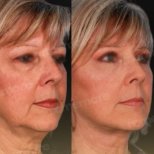 Vorher-nachher-Ergebnis Deep Plane Facelift bei Memorial Göztepe Hospital, Gesichtsverjüngung