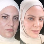 Vorher-nachher-Ergebnis Deep Plane Facelift bei Memorial Göztepe Hospital, Gesichtsverjüngung