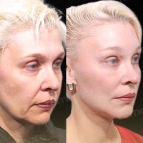 Vorher-nachher-Ergebnis Deep Plane Facelift bei Memorial Göztepe Hospital, Gesichtsverjüngung
