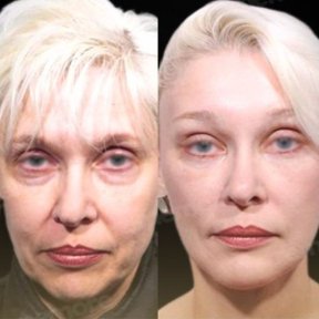 Vorher-nachher-Ergebnis Deep Plane Facelift bei Memorial Göztepe Hospital, Gesichtsverjüngung