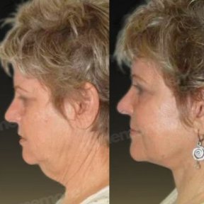 Vorher-nachher-Ergebnis Deep Plane Facelift bei Memorial Göztepe Hospital, Gesichtsverjüngung