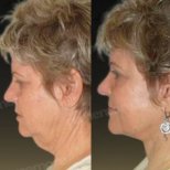 Vorher-nachher-Ergebnis Deep Plane Facelift bei Memorial Göztepe Hospital, Gesichtsverjüngung