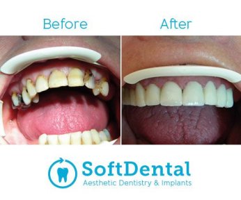 Vorher-nachher-Ergebnis Zahnimplantat mit Abutment bei SoftDentalCare Clinic, Lächeln erneuert