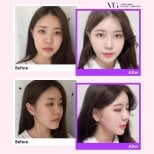 Результаты ринопластики до и после в VG Plastic Surgery, коррекция носа и гармония лица
